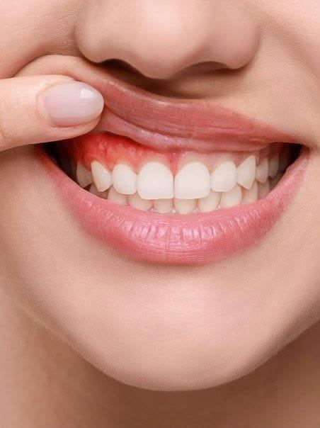 My gums are bleeding. What should I do?